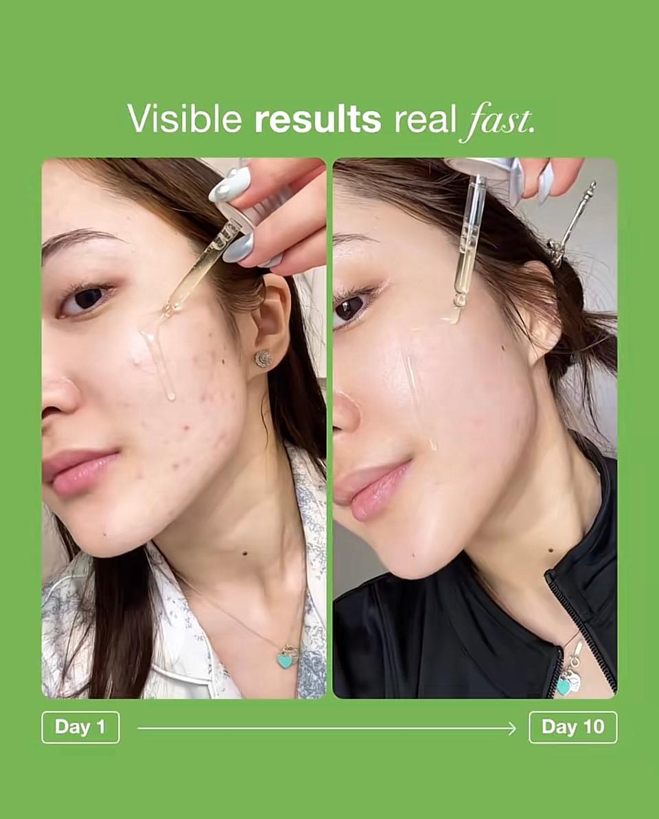 Anuaເຊລ້ຳAzelaic acid — 4