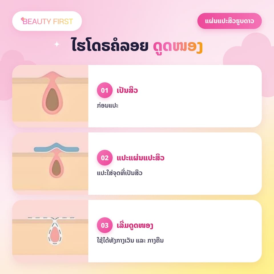 ແຜ່ນແປະສິວຮູບດາວ ACNE PATCH (51ດວງ ແຜ່ນ) – ແຜ່ນແປະສິວໄຮໂດຣຄໍລອຍ (Hydrocolloid) ຮູບດາວສຸດນ່າຮັກ, ຊ່ວຍປົກປິດຮອຍ, ດູດໜອງ, ຫຼຸດການອັກເສບ ແລະ ຮັກສາສິວ. ໃຊ້ໄດ້ທັງກາງເວັນ ແລະ ກາງຄືນ, ເໝາະສຳລັບນັກຮຽນ-ນັກສຶກສາ — 5