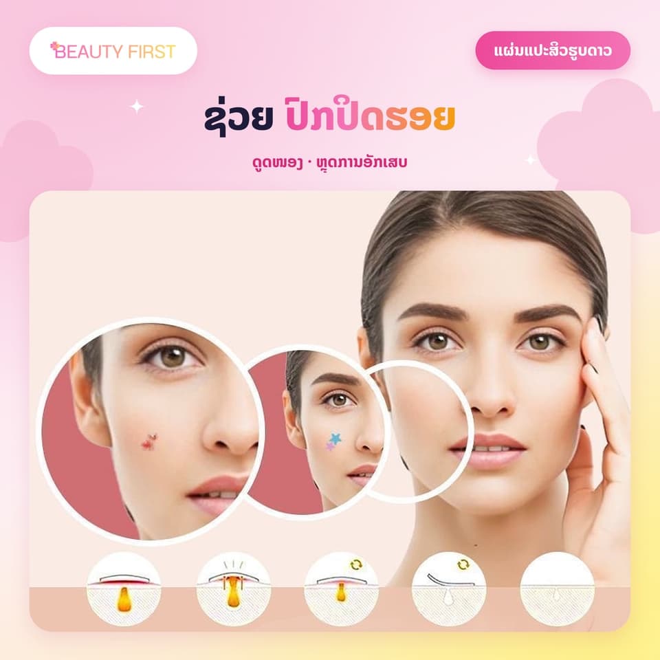 ແຜ່ນແປະສິວຮູບດາວ ACNE PATCH (51ດວງ ແຜ່ນ) – ແຜ່ນແປະສິວໄຮໂດຣຄໍລອຍ (Hydrocolloid) ຮູບດາວສຸດນ່າຮັກ, ຊ່ວຍປົກປິດຮອຍ, ດູດໜອງ, ຫຼຸດການອັກເສບ ແລະ ຮັກສາສິວ. ໃຊ້ໄດ້ທັງກາງເວັນ ແລະ ກາງຄືນ, ເໝາະສຳລັບນັກຮຽນ-ນັກສຶກສາ — 4